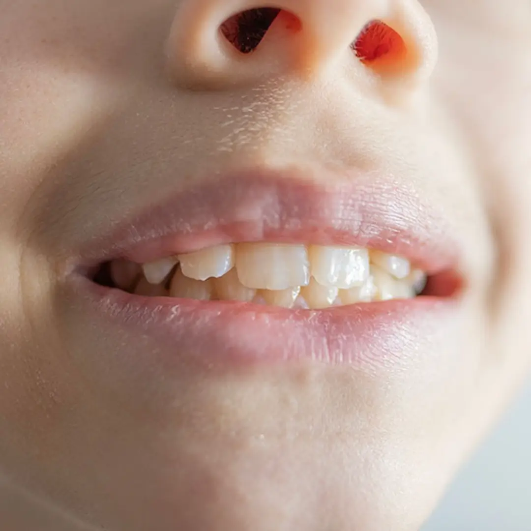 child gum disease 2024 620 (1)