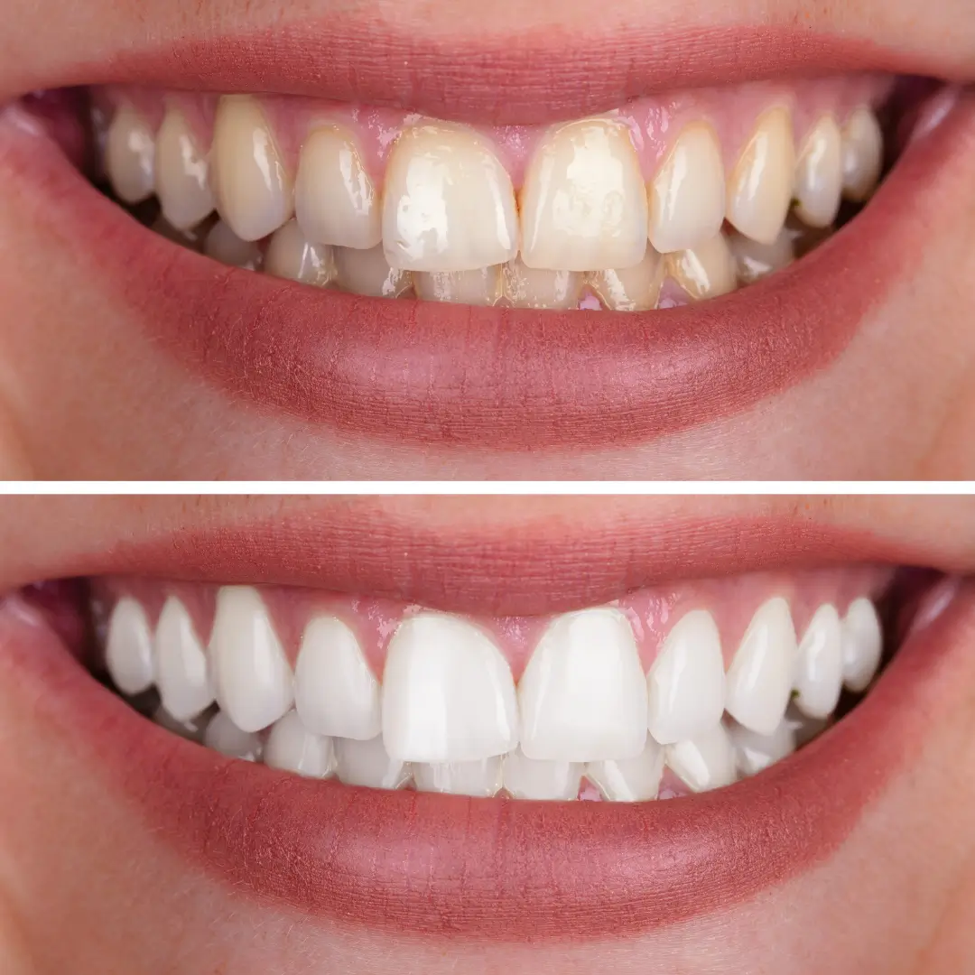 https://vistaridgedental.com/wp-content/uploads/2025/10/teeth-whitening-4-1.webp